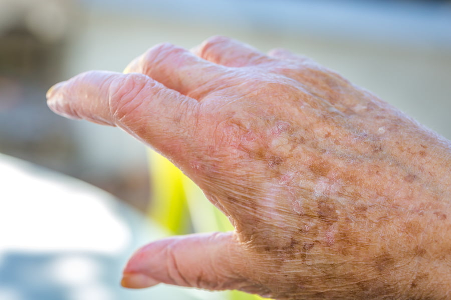 Dealing with Skin Irritation at the End of Life